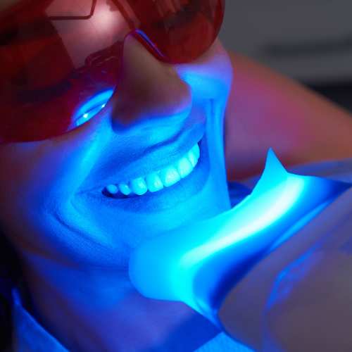 How Do People Like You Choose Between At-Home and In-Clinic Whitening Banbury?