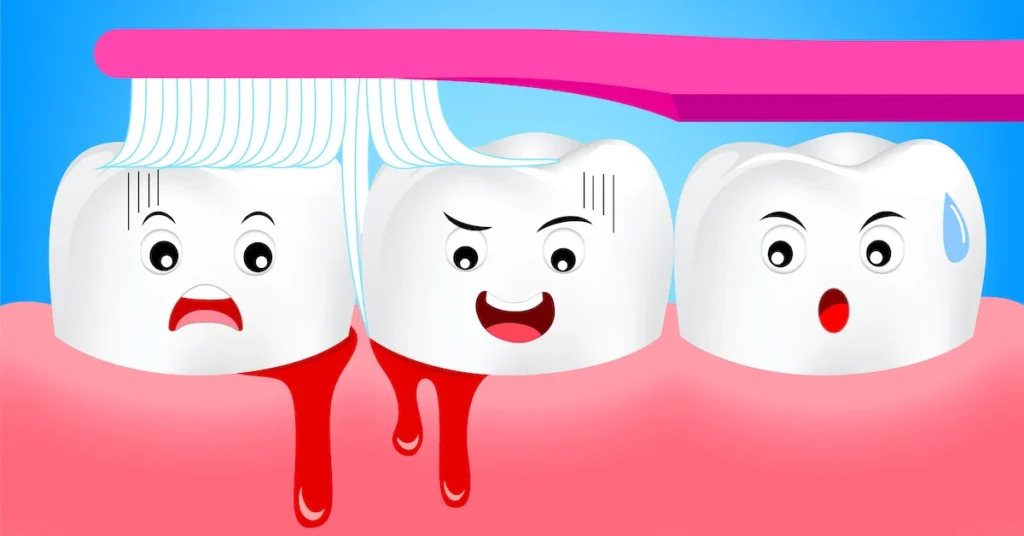 Is Bleeding Gums an Early Sign of Gum Disease Banbury?