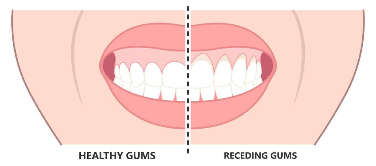 What Causes Gums to Recede Over Time Banbury